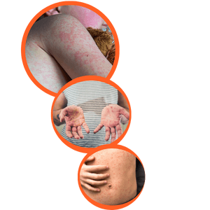 Three images of examples of measles on skin. Arms, hands and abdomen